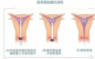 避孕套介绍